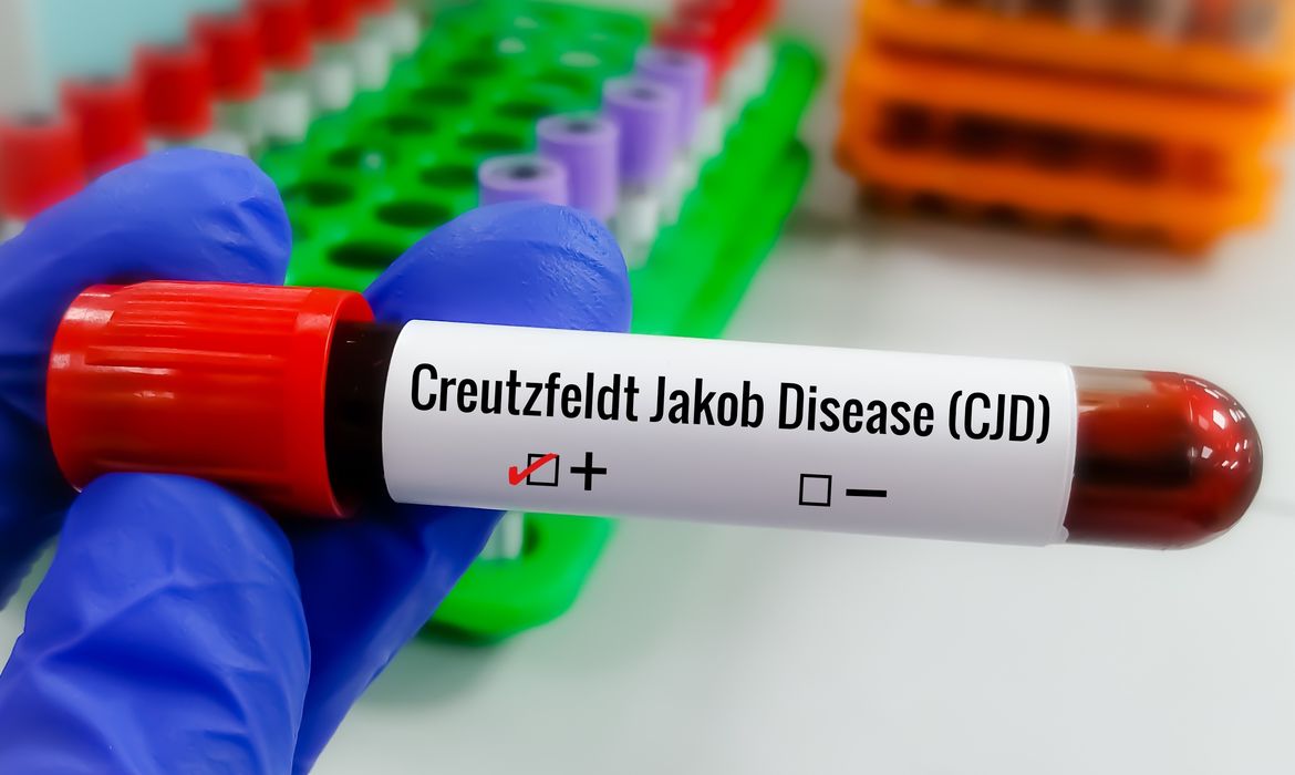 Creutzfeldt-Jakob: doença rara ainda não tem cura conhecida